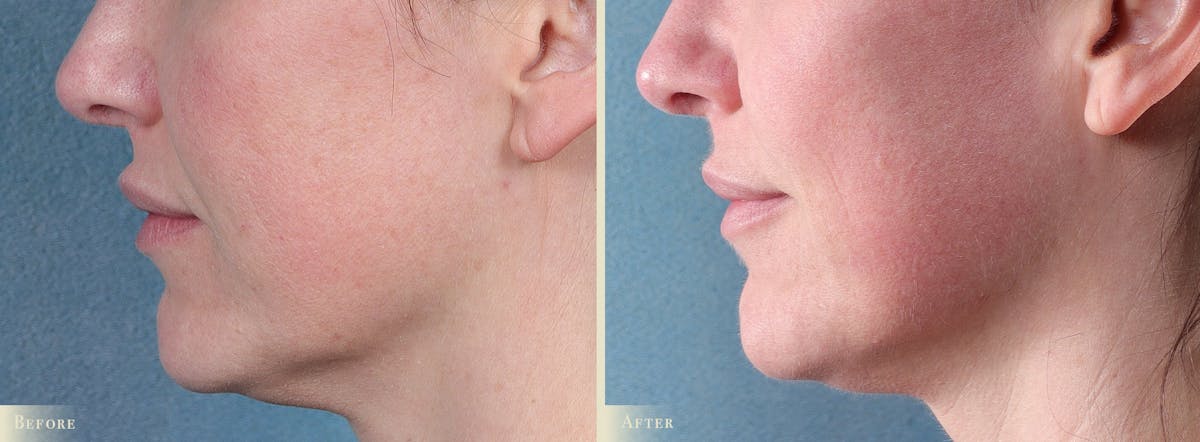 CO2 Laser Resurfacing Before & After Gallery - Patient 350992 - Image 3