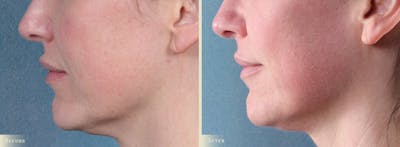 CO2 Laser Resurfacing Before & After Gallery - Patient 350992 - Image 3