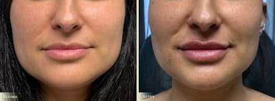 Lip Augmentation Before & After Gallery - Patient 287714 - Image 1