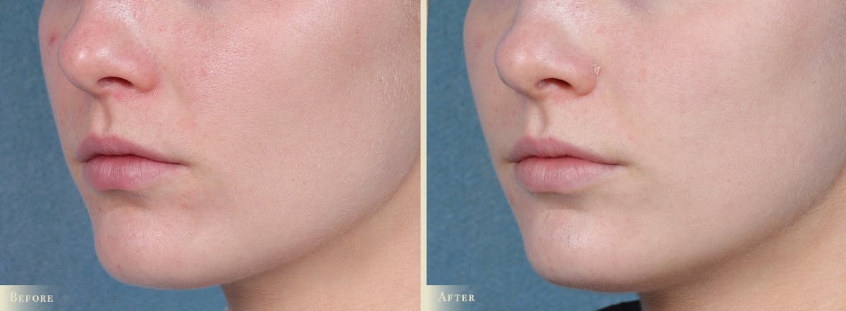 CO2 Laser Resurfacing Before & After Gallery - Patient 116675 - Image 1