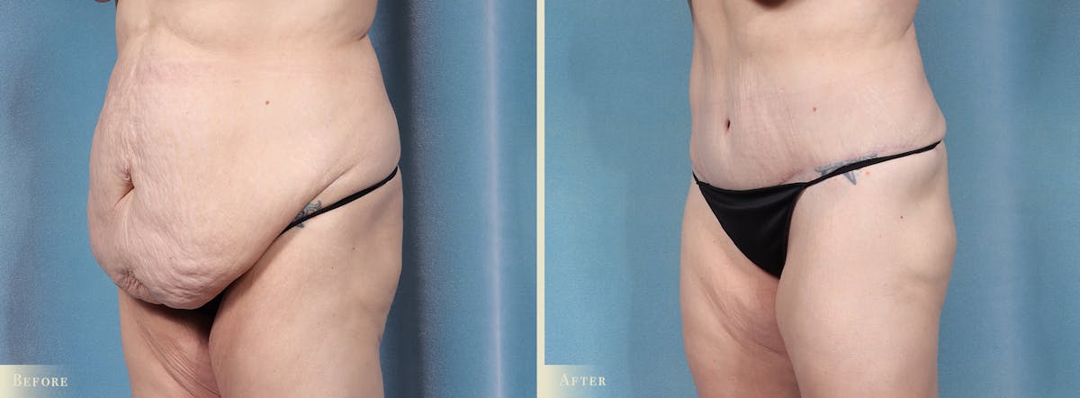 Tummy Tuck Before & After Gallery - Patient 174934 - Image 2