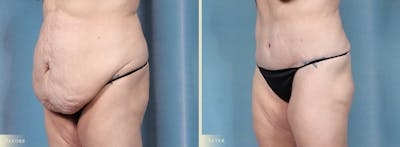 Tummy Tuck Before & After Gallery - Patient 174934 - Image 2