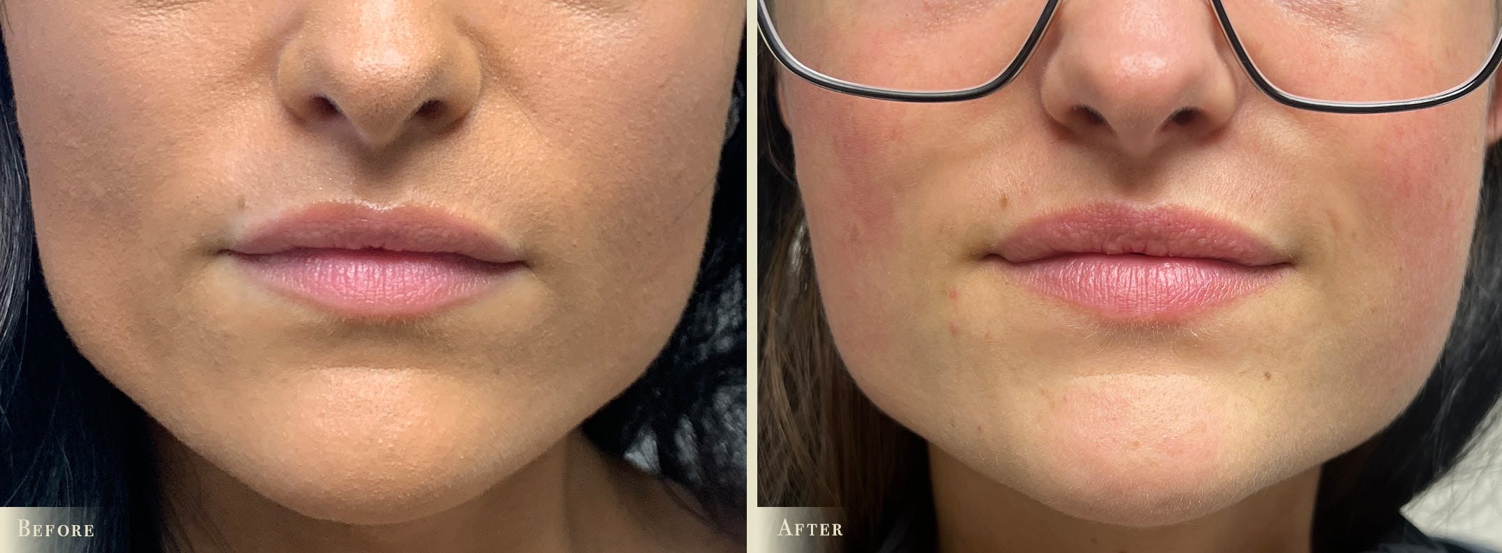 Lip Augmentation Before & After Gallery - Patient 341516 - Image 1
