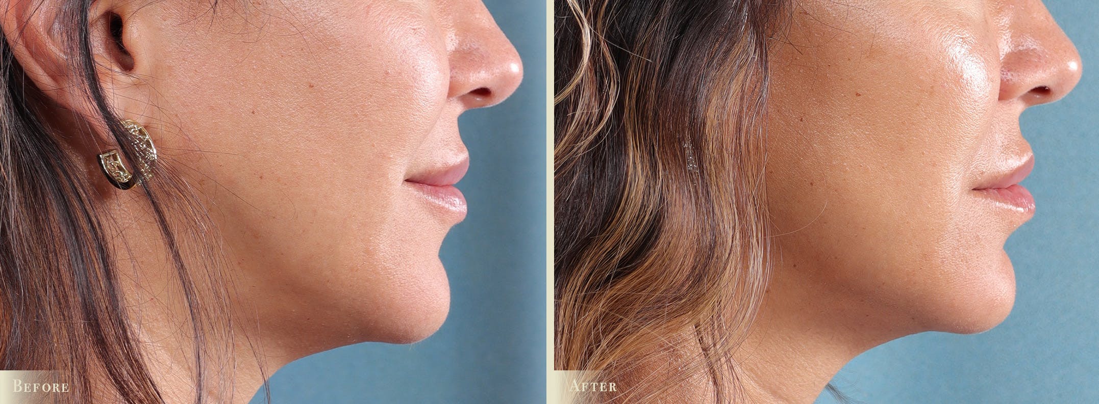 Microneedling Before & After Gallery - Patient 202138 - Image 2