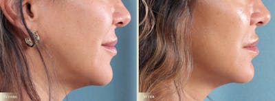Microneedling Before & After Gallery - Patient 202138 - Image 2