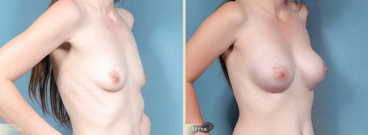 Breast Augmentation Before & After Gallery - Patient 382575 - Image 2