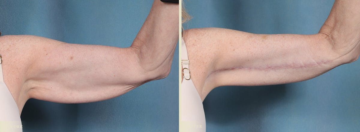 Arm Lift Before & After Gallery - Patient 410869 - Image 1