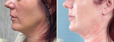 Lip Augmentation Before & After Gallery - Patient 420629 - Image 3