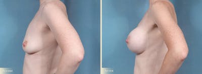 Breast Augmentation Before & After Gallery - Patient 121286 - Image 3