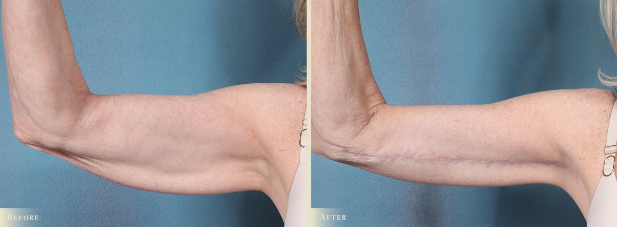 Arm Lift Before & After Gallery - Patient 410869 - Image 4
