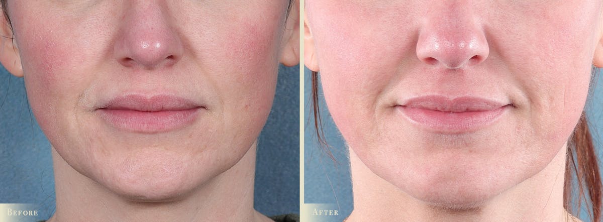 CO2 Laser Resurfacing Before & After Gallery - Patient 350992 - Image 1