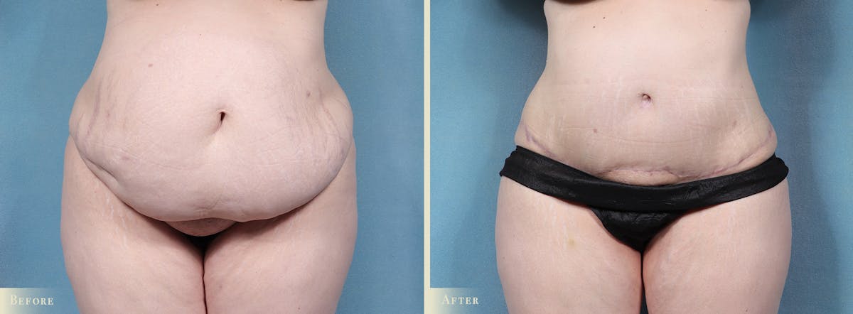Tummy Tuck Before & After Gallery - Patient 336558 - Image 1