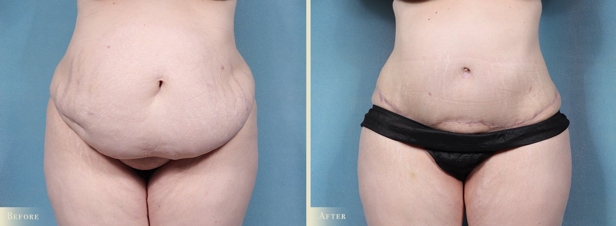 Tummy Tuck Before & After Gallery - Patient 336558 - Image 1