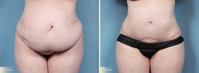 Tummy Tuck Before & After Gallery - Patient 336558 - Image 1