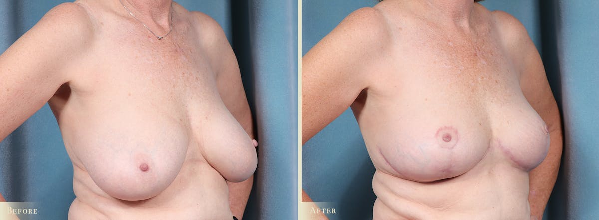 Breast Reduction Before & After Gallery - Patient 321418 - Image 2