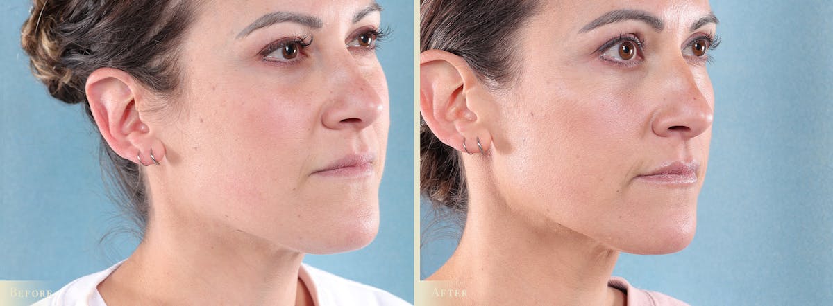 Botox® and Fillers Before & After Gallery - Patient 362734 - Image 2
