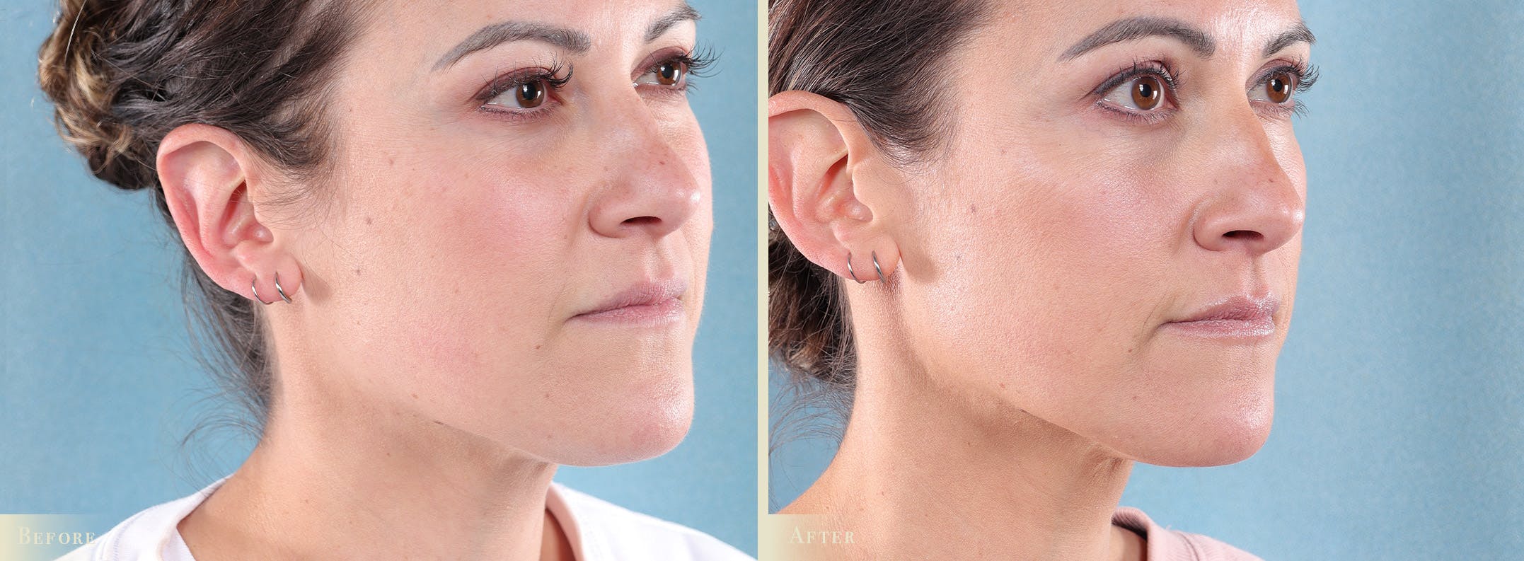 Botox® and Fillers Before & After Gallery - Patient 362734 - Image 2