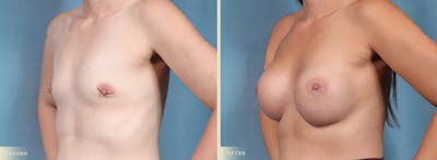 Breast Augmentation Before & After Gallery - Patient 211375 - Image 2
