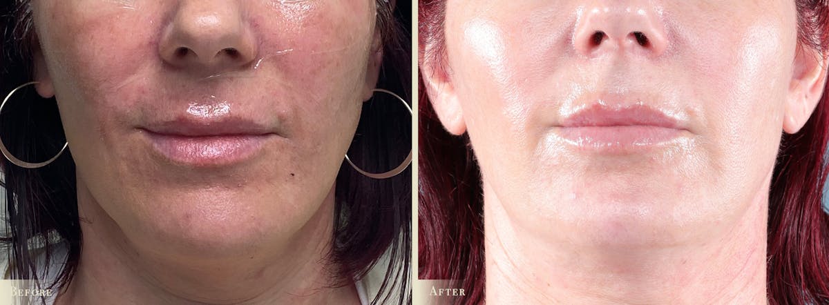 Lip Augmentation Before & After Gallery - Patient 420629 - Image 1