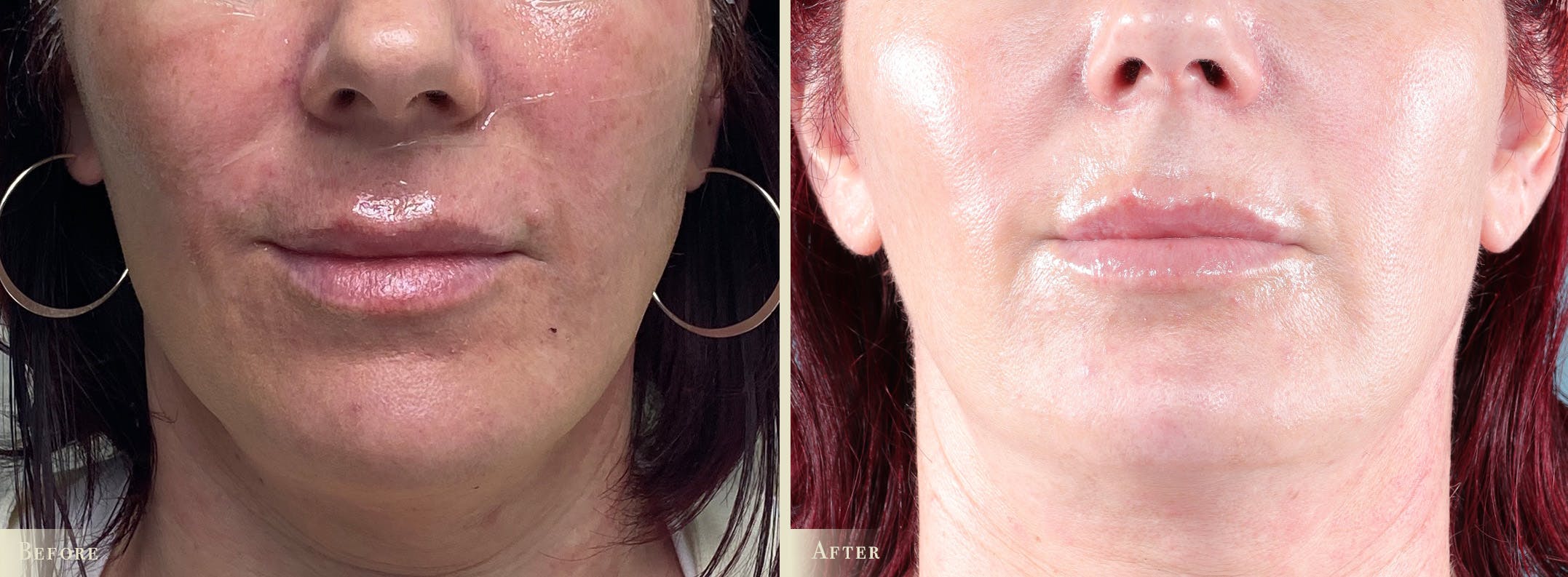 Lip Augmentation Before & After Gallery - Patient 420629 - Image 1