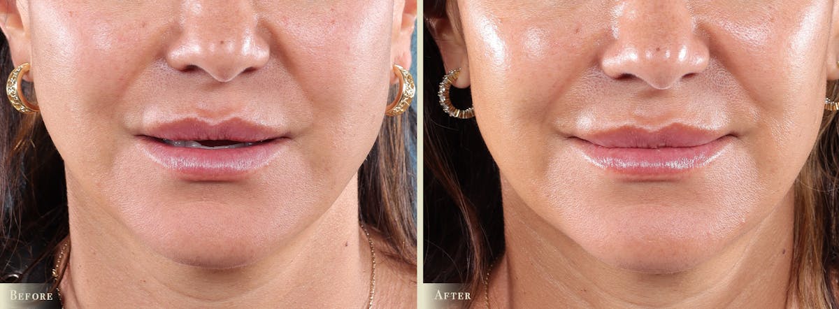 Microneedling Before & After Gallery - Patient 202138 - Image 1