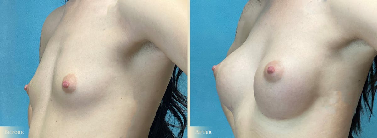 Breast Augmentation Before & After Gallery - Patient 232219 - Image 2