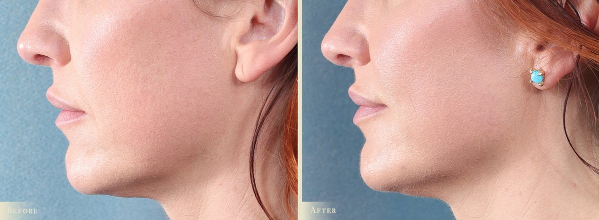 Lip Augmentation Before & After Gallery - Patient 186660 - Image 3