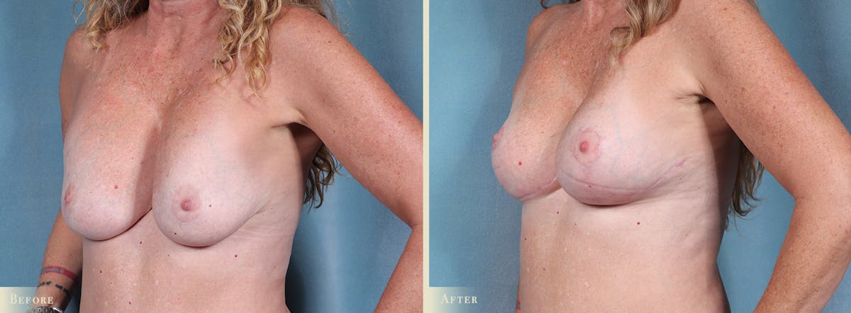 Breast Augmentation and Lift  Before & After Gallery - Patient 268862 - Image 2