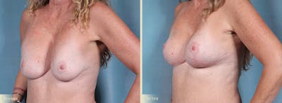 Breast Augmentation and Lift Before & After Gallery - Patient 268862 - Image 2
