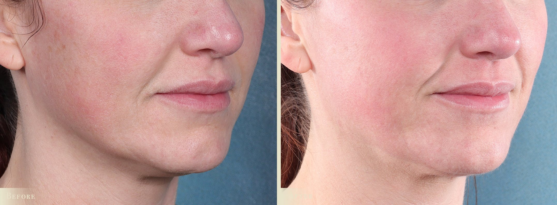 CO2 Laser Resurfacing Before & After Gallery - Patient 350992 - Image 2
