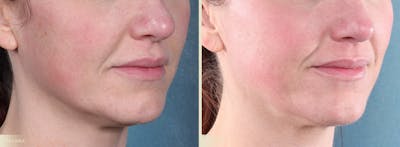 CO2 Laser Resurfacing Before & After Gallery - Patient 350992 - Image 2
