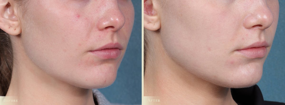 CO2 Laser Resurfacing Before & After Gallery - Patient 116675 - Image 2
