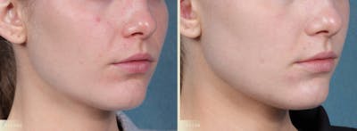 CO2 Laser Resurfacing Before & After Gallery - Patient 116675 - Image 2