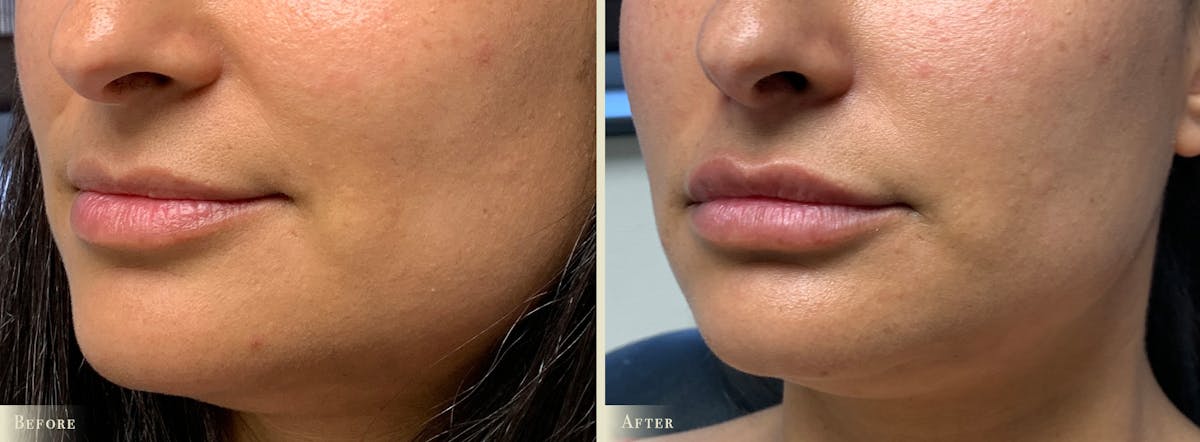 Lip Augmentation Before & After Gallery - Patient 287714 - Image 2