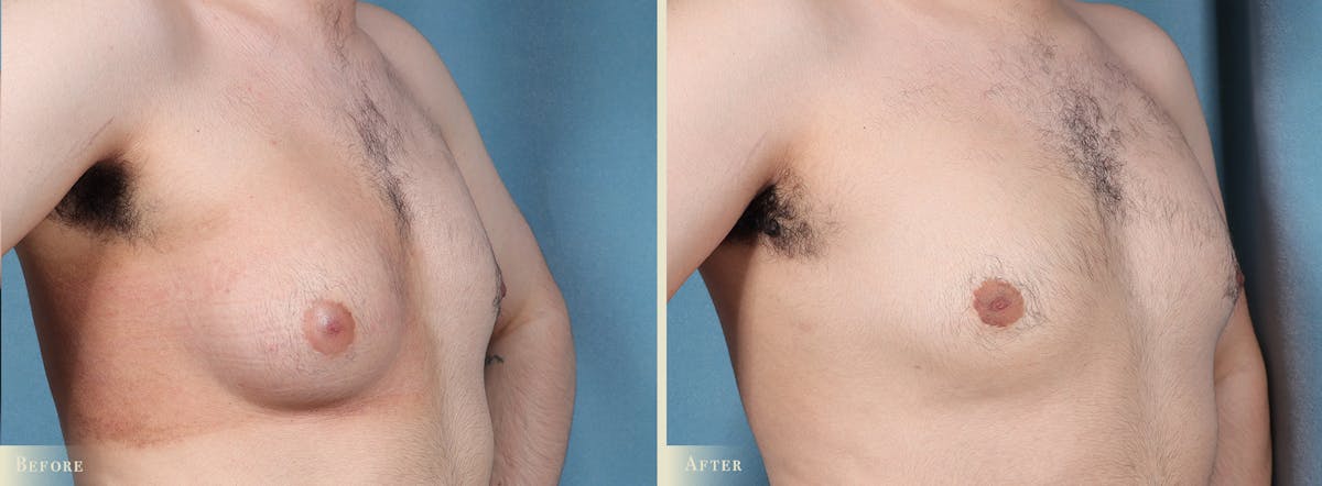 Male Breast Reduction (Gynecomastia) Before & After Gallery - Patient 205100 - Image 2