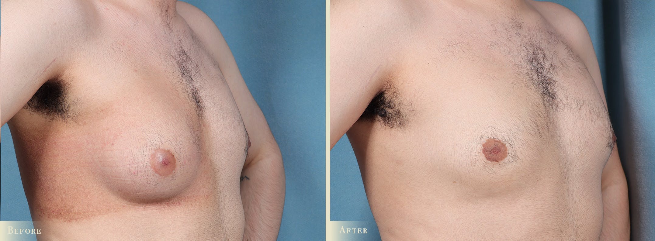 Male Breast Reduction (Gynecomastia) Before & After Gallery - Patient 205100 - Image 2