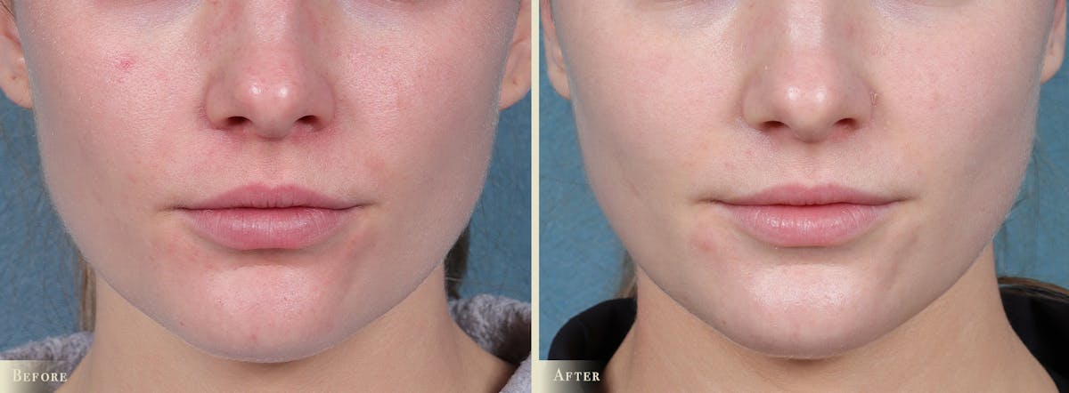 Lip Augmentation Before & After Gallery - Patient 186660 - Image 1