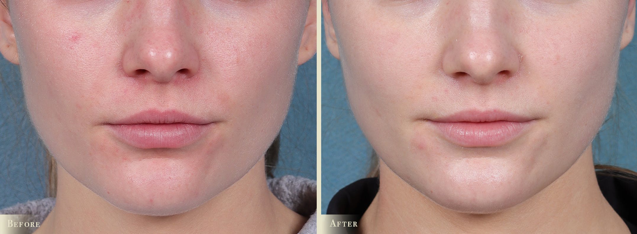 Lip Augmentation Before & After Gallery - Patient 186660 - Image 1