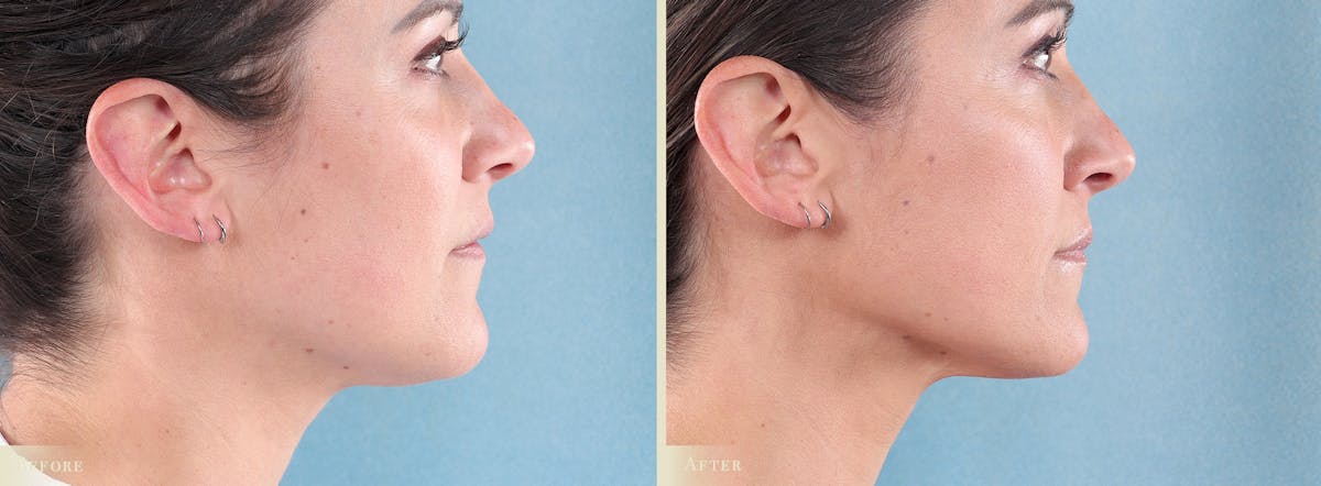 Botox® and Fillers Before & After Gallery - Patient 362734 - Image 3
