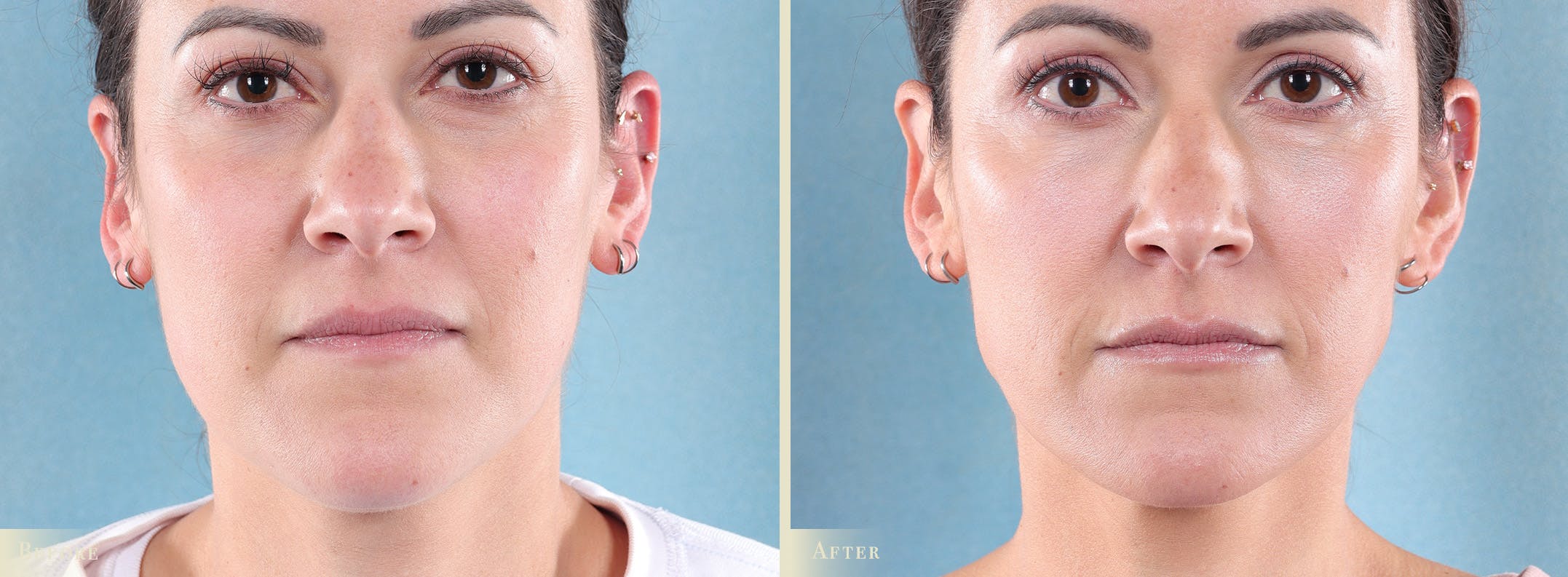 Botox® and Fillers Before & After Gallery - Patient 362734 - Image 1