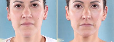 Botox® and Fillers Before & After Gallery - Patient 362734 - Image 1