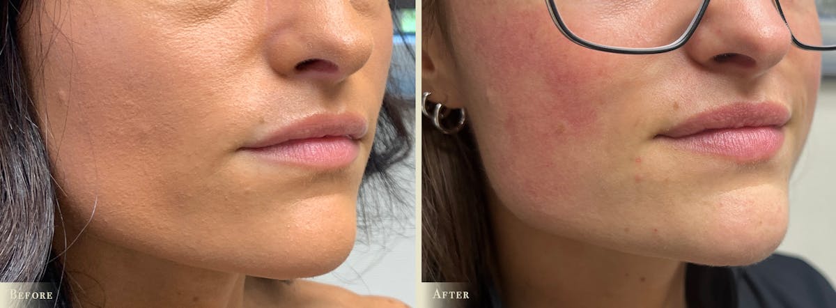 Lip Augmentation Before & After Gallery - Patient 341516 - Image 2