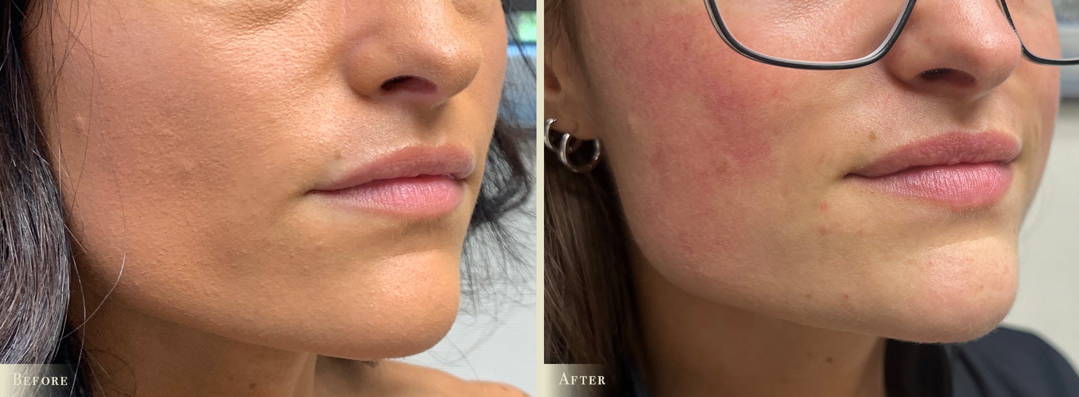 Lip Augmentation Before & After Gallery - Patient 341516 - Image 2