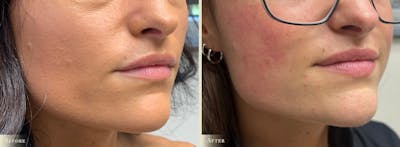 Lip Augmentation Before & After Gallery - Patient 341516 - Image 2