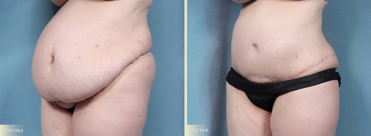 Tummy Tuck Before & After Gallery - Patient 336558 - Image 2