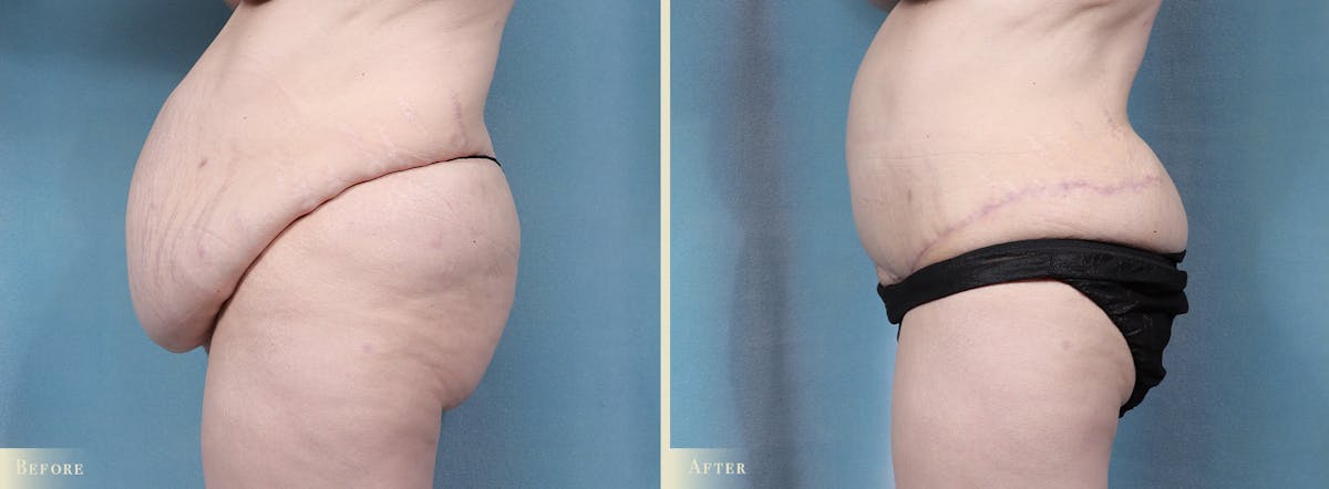 Tummy Tuck Before & After Gallery - Patient 336558 - Image 3