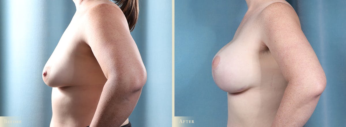 Breast Augmentation and Lift  Before & After Gallery - Patient 437825 - Image 3