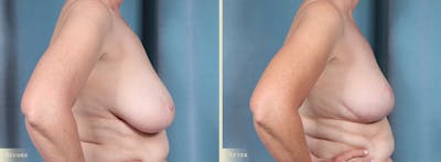 Breast Reduction Before & After Gallery - Patient 321418 - Image 3