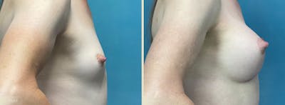 Breast Augmentation Before & After Gallery - Patient 988893 - Image 3