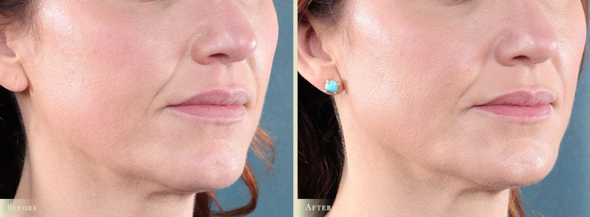 Lip Augmentation Before & After Gallery - Patient 186660 - Image 2